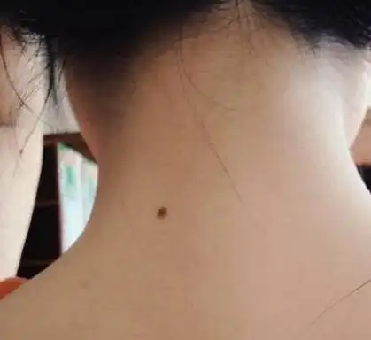 脖子有一物,财运挡不住,脖子有这些痣,男旺财,女旺夫,富贵命