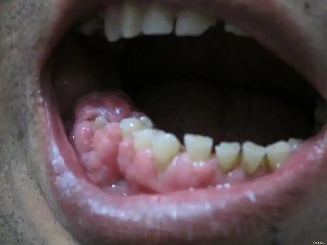 【求助】牙龈增生图片,治疗,请大家支招