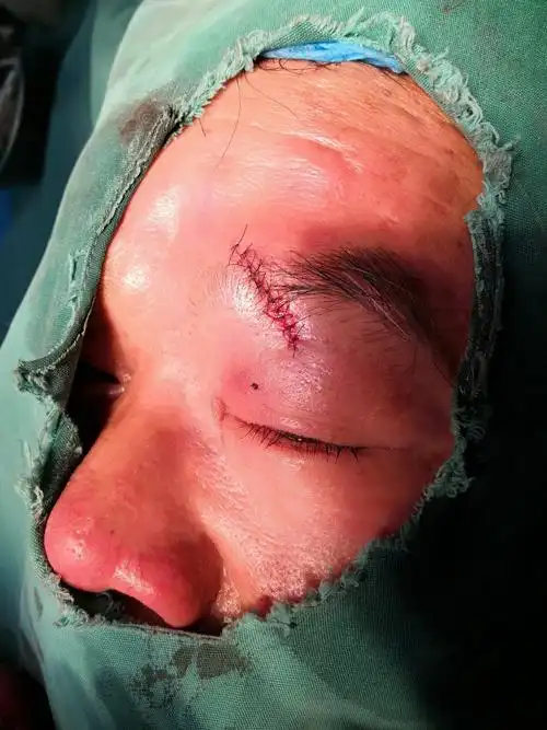 我为患者做眼睑裂伤清创缝合手术术后情况