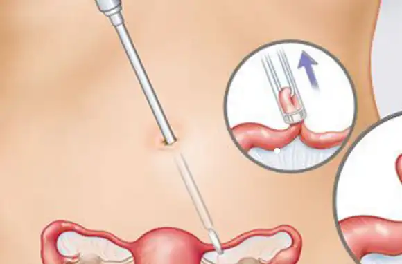 女人做结扎手术原来会有这么多影响,可惜还有很多人不知道!