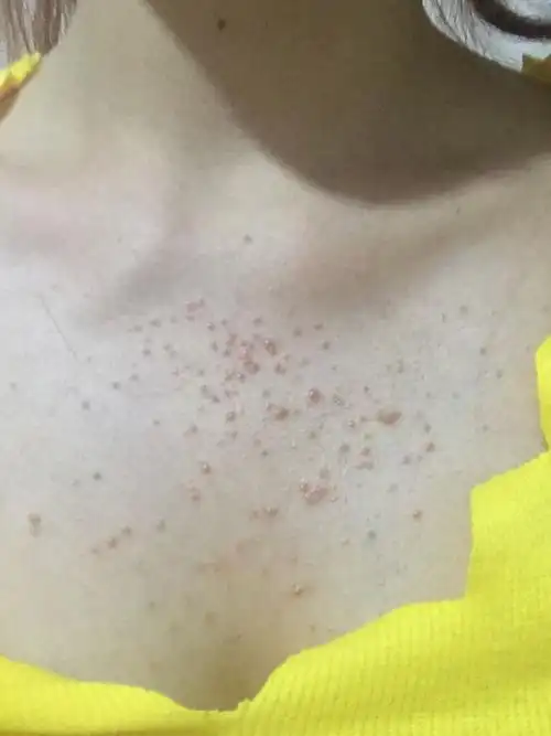 胸前起了一片类似粉刺的小红痘痘里面像是有白头之类的东西