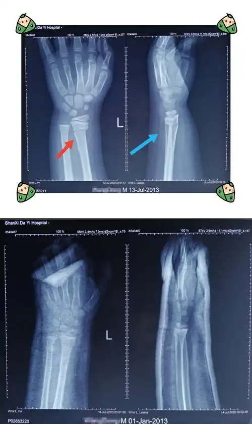 男孩,7岁,左桡骨远端骨折