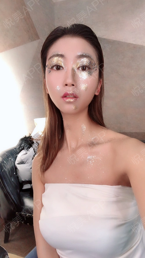 乳房下垂矫正术后18天_乳头内陷矫正术后18天_假体隆胸术后18天_胸型