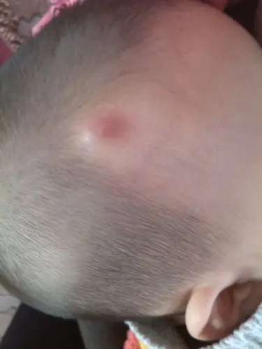 宝宝现在8个月了,在5个月的时候额头右边长了个囊肿,现在发红了,去