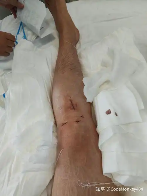 北医三院 前交叉韧带断裂 入院记录 - 知乎