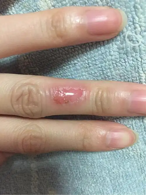 慎入 手指烫成这样 可以抹紫药水么?