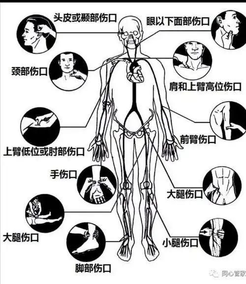 外伤致肢(指)体离断患者的院前四步紧急处理