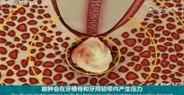 牙龈起脓包可以自行戳破吗叶子口腔科普