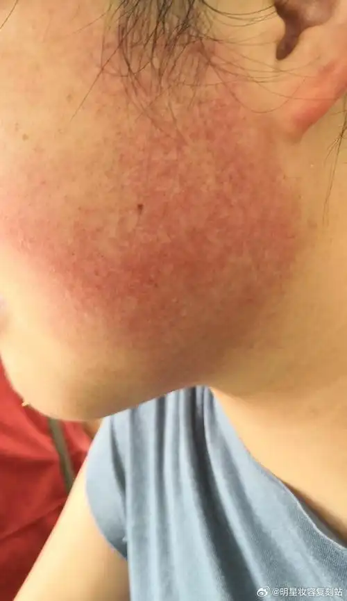 面部及颈部的毛囊性红斑黑变病是一种皮肤病变,通常需要进行#美容#和