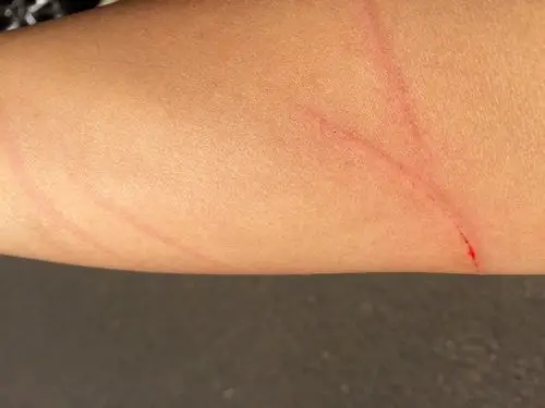 被自家泰迪抓伤了,要不要打针呀,自家狗打过狂犬疫苗的