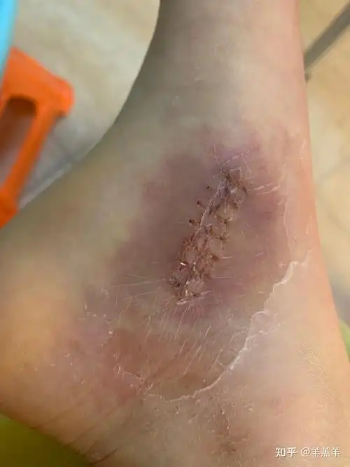 副舟骨术后 - 知乎