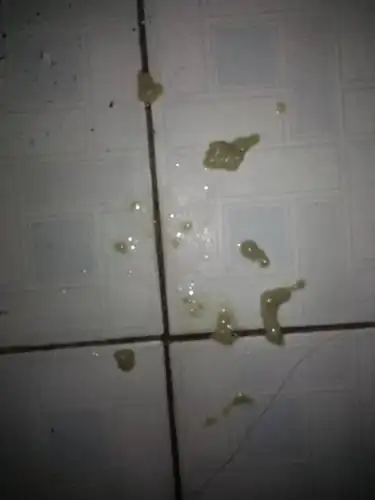 每天都会咳出这样的痰,有问题吗?