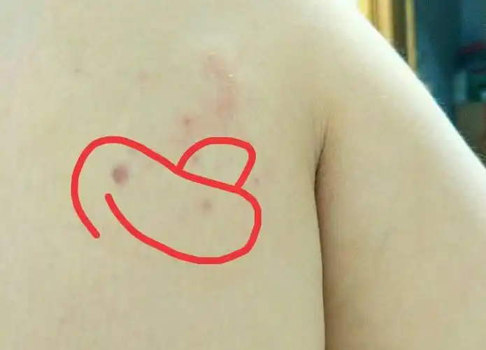 被蚊子咬了之后第二天晚上出现一个皮下血点