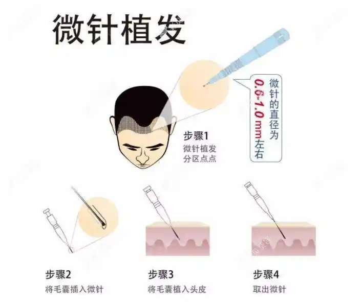微针植发过程图解