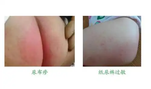尿布疹和"纸尿裤过敏"你分清了吗?选对纸尿裤,跟红屁屁说拜!