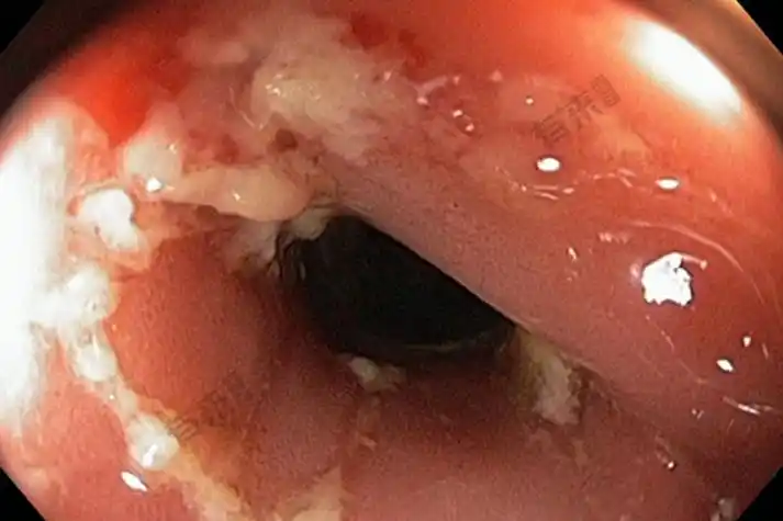 肛门癌的早期症状图片