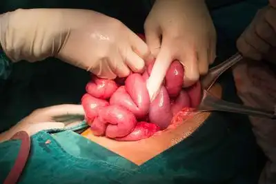 肠扭转复位手术的费用大概要多少