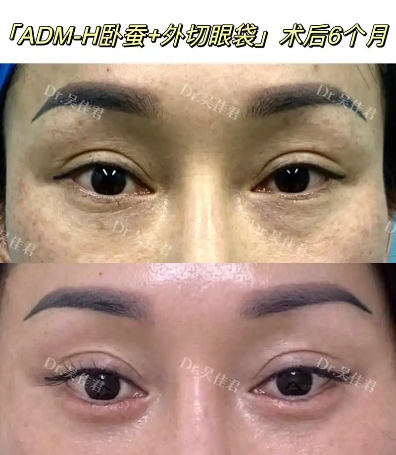 「adm-h卧蚕 外切眼袋」术后6个月  谢谢姑娘发来的长期反馈,姑娘术前