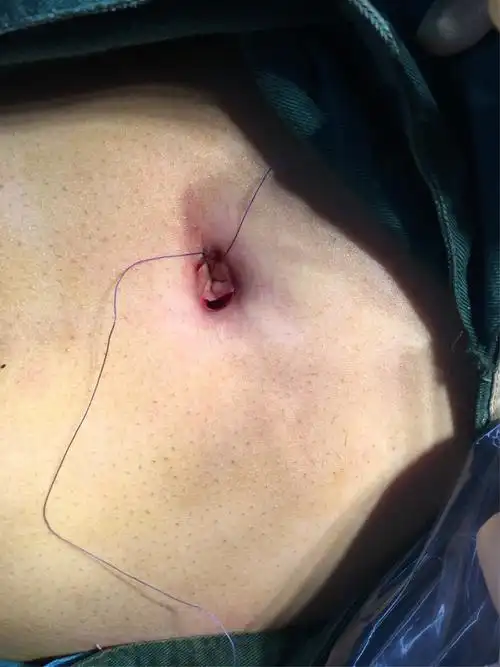 "单人单手单器械单孔"腹腔镜下双侧精索静脉曲张高位结扎术 肠粘连松