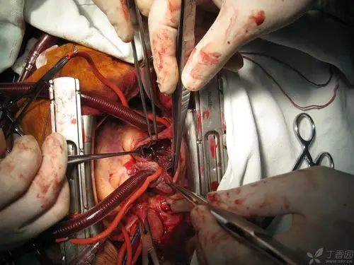 房缺封堵器脱落,开胸手术一例(术中图片). [病例帖]