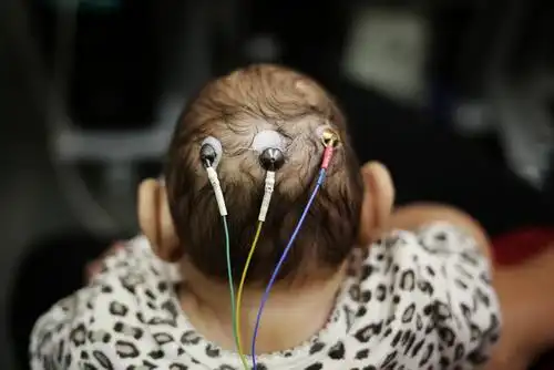 波多黎各出现首例寨卡病毒引发的胎儿头小症