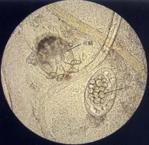 疥螨科螨虫呈微黄白色圆形或龟形,背面隆起,腹面扁平且有四对足.
