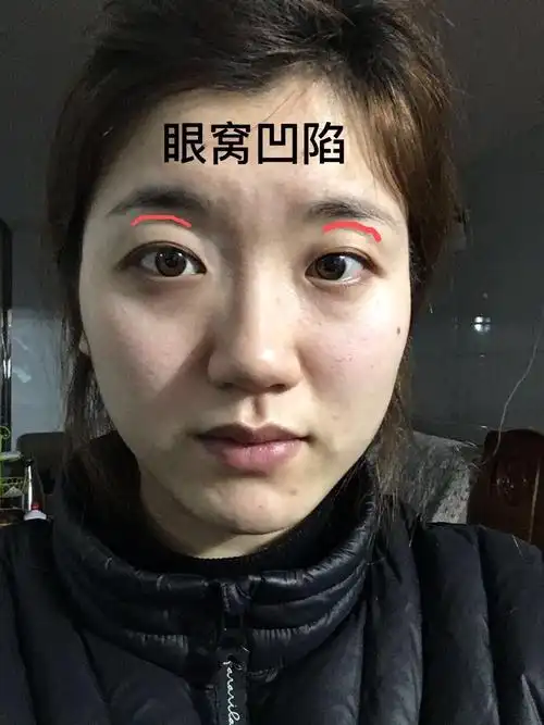 闲着没事大家帮我看看吧,眼窝凹陷,眼皮也有点睁不开的感觉,怎么调整