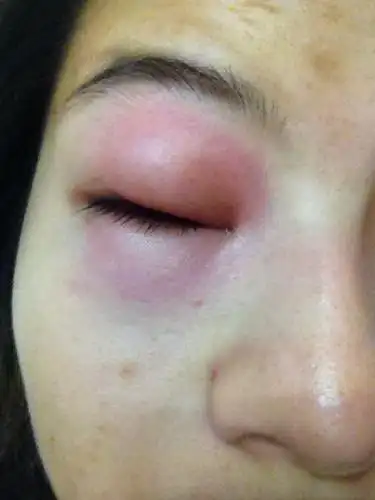 问:眼睛感染肿了,眼睛几乎看不见,怎么办?谢谢大家解答!