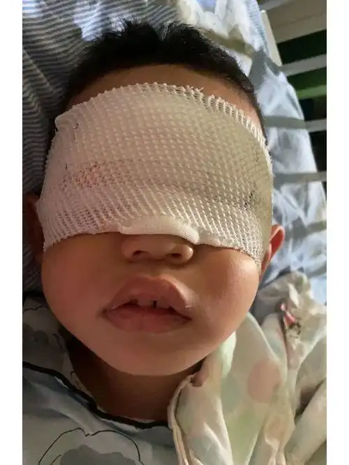 倒睫手术睑内翻