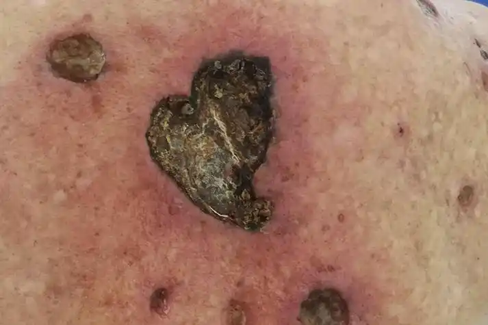 背部鳞状细胞癌图