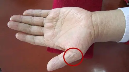 ① 大拇指根部在我们手掌4个位置出现的青筋,可能预示有心脑血管疾病