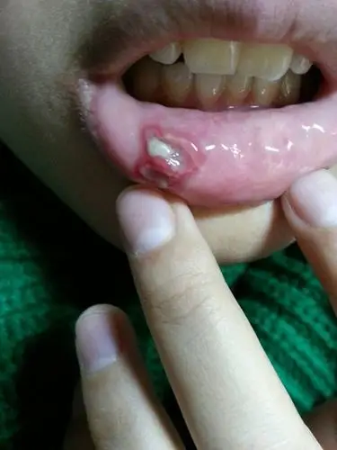 口腔癌图片_口腔癌症状表现图片大全_有来医生