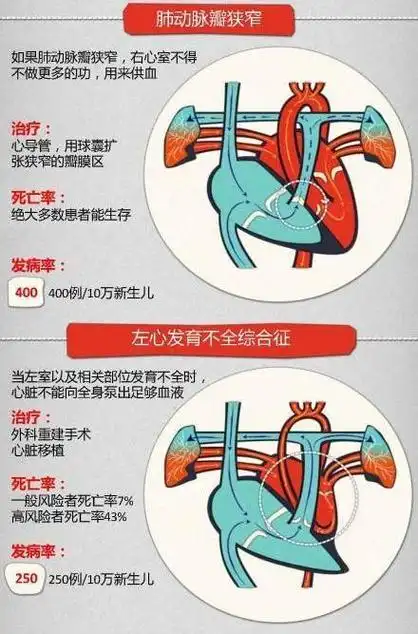 一图读懂先天性心脏病(转载)