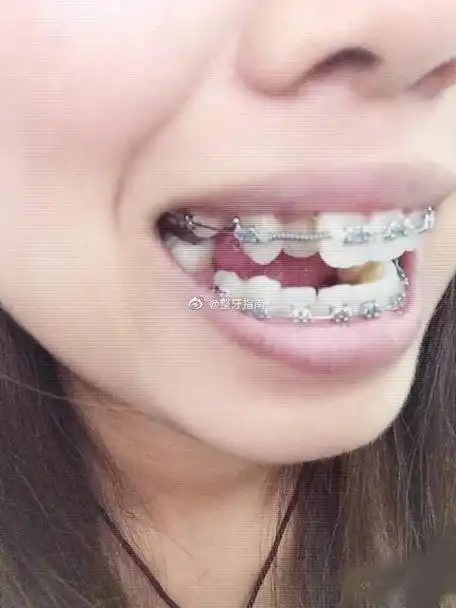 成都虎牙矫正##小虎牙