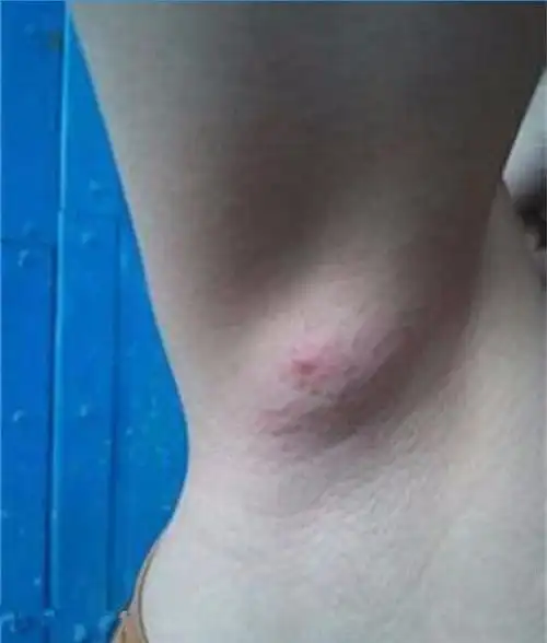 女子为美拔光腋毛,一星期后腋下长出硬块,检查报告吓哭女子!_网易订阅