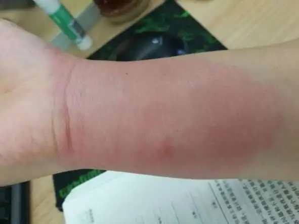 红火蚁咬了红肿痒涂什么药红火蚁咬伤后图片