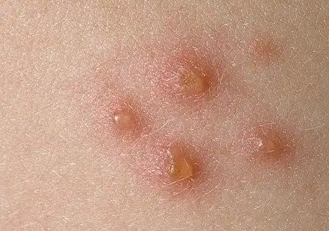 脓疱型银屑病水泡图片