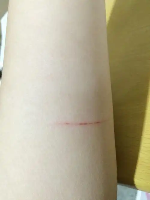 被猫抓伤意外险报销吗 被猫抓伤可以报保险吗