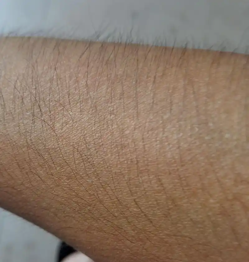 为什么有的女生汗毛多,有的女生汗毛少呢?