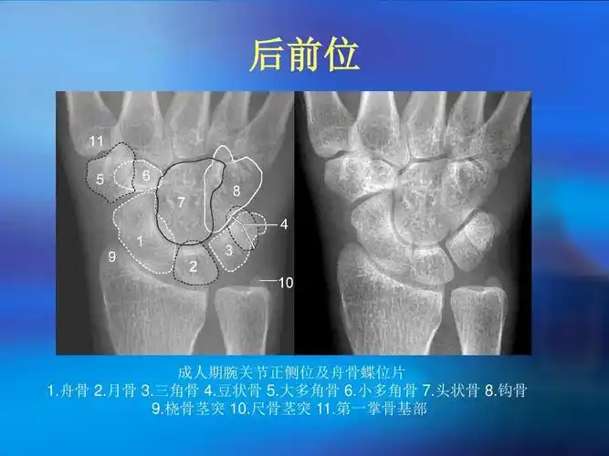 腕部骨折与脱位ppt