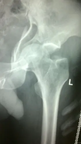 髋关节中心性脱位