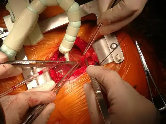 降支系统的病变,可以通过左前外小切口来完成心脏不停跳冠脉搭桥手术