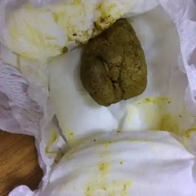 我家宝宝现在一岁了,总是少则三天多则六七天拉