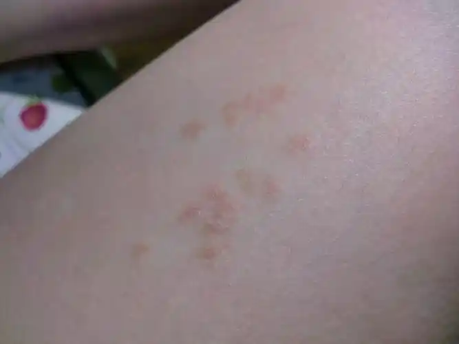 大腿上一些皮肤变成了红色的.一长就是一片.是什么原因造成的呢?