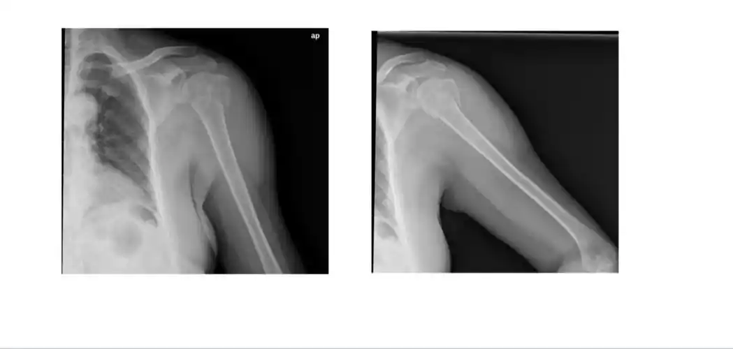 这是一例外翻嵌插的骨折,肱骨头的外翻单纯靠牵引是不能纠正的