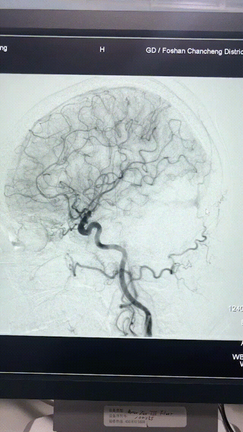 脑血管造影的三维图像