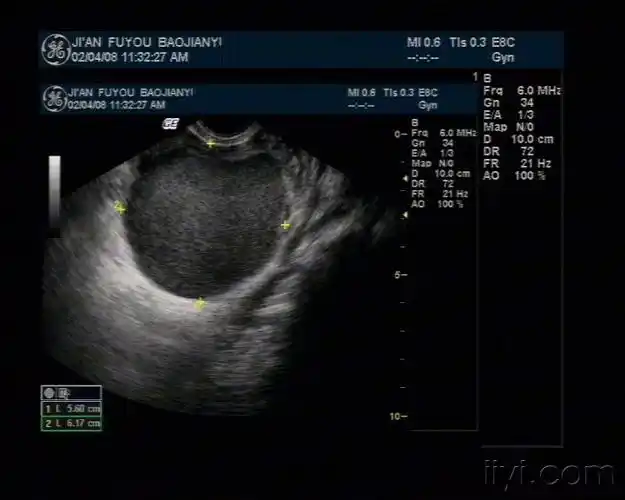 典型的巧克力囊肿 - 超声医学讨论版 - 爱爱医医学论坛