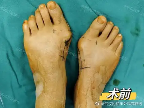 微博健康公开课##拇外翻##协和郑怀远教授