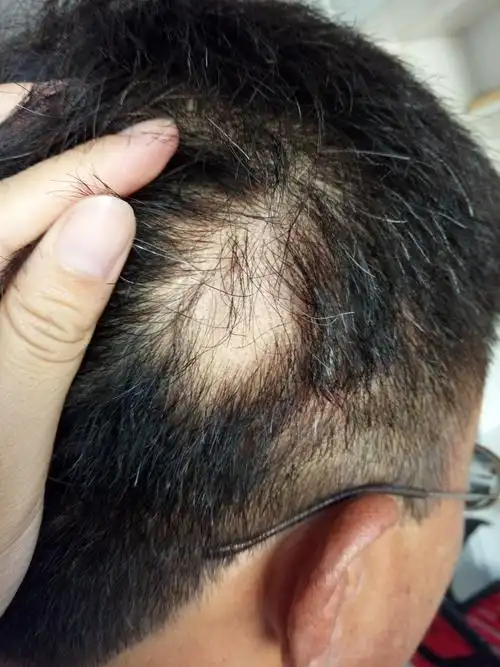 掉头发