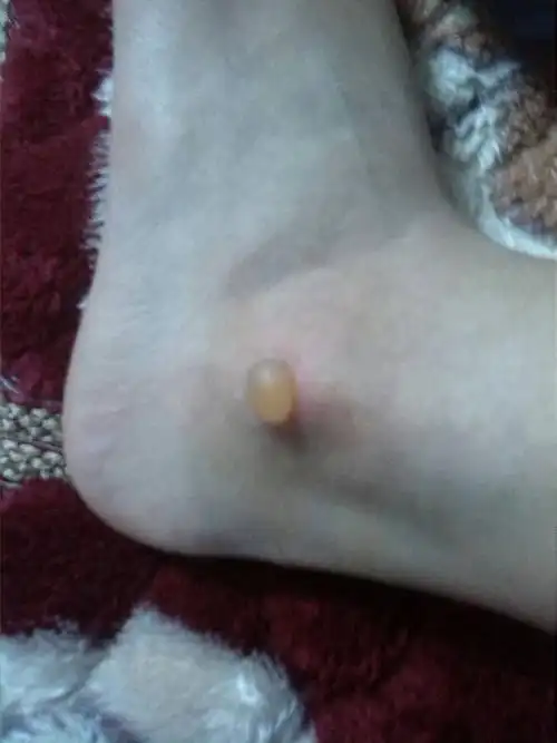 脚踝上突然起了个水泡,昨天晚上一点事都没有,早上一起来就这样,就